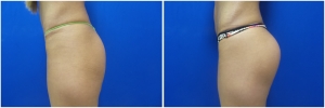 buttock-implants-before-after-21-1