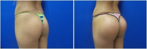 buttock-implants-before-after-21-2