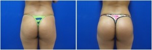 buttock-implants-before-after-21-3