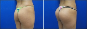 buttock-implants-before-after-21-4