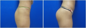 buttock-implants-before-after-21-5