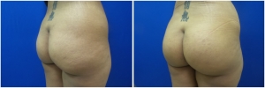 buttock-implants-before-after-23-1