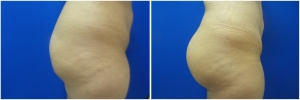 buttock-implants-before-after-23-2