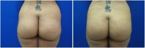 buttock-implants-before-after-23-3