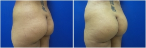 buttock-implants-before-after-23-4