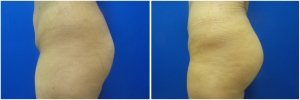 buttock-implants-before-after-23-5