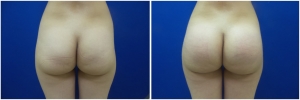 buttock-implants-before-after-24-1