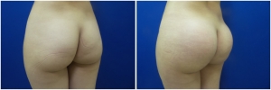 buttock-implants-before-after-24-2