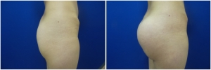 buttock-implants-before-after-24-3