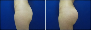 buttock-implants-before-after-24-4