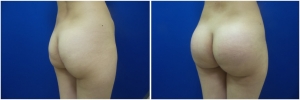 buttock-implants-before-after-24-5