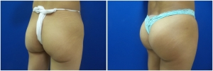 buttock-implants-before-after-25-1