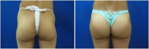 buttock-implants-before-after-25-2
