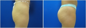buttock-implants-before-after-25-3