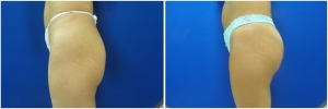 buttock-implants-before-after-25-4