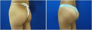 buttock-implants-before-after-25-5