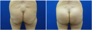 buttock-implants-before-after-29-1