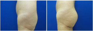 buttock-implants-before-after-29-2