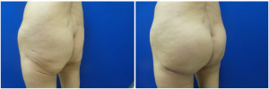 buttock-implants-before-after-29-3