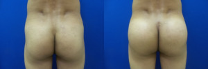 buttock-implants-before-after-30-1