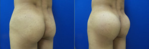 buttock-implants-before-after-30-2