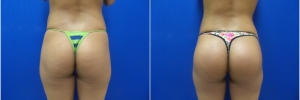 buttock-implants1-1