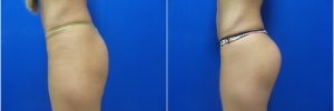 buttock-implants1-2