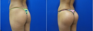 buttock-implants1-3