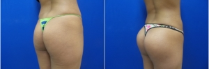 buttock-implants1-4