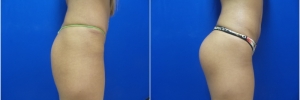 buttock-implants1-5