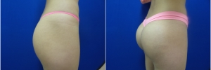 buttockimplants1