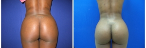 buttockimplants3