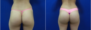 buttockimplants3