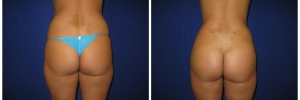 buttockimplantsliposuction20