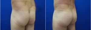 male-buttock-implants-1
