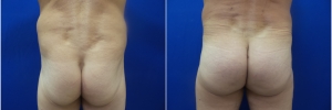 male-buttock-implants-2