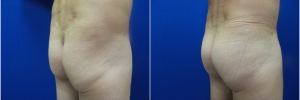 male-buttock-implants-3