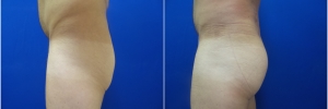 male-buttock-implants-4