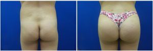 buttock-augmentation-fat-transfer-10-1