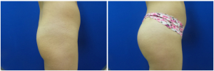 buttock-augmentation-fat-transfer-10-2
