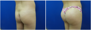 buttock-augmentation-fat-transfer-10-3