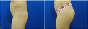 buttock-augmentation-fat-transfer-10-4