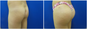 buttock-augmentation-fat-transfer-10-5