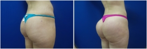 buttock-augmentation-fat-transfer-9-1