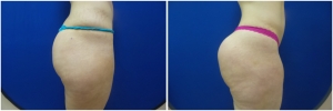 buttock-augmentation-fat-transfer-9-2