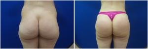 buttock-augmentation-fat-transfer-9-3