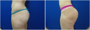 buttock-augmentation-fat-transfer-9-4