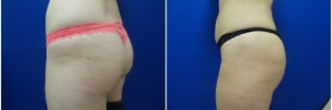 buttock-fat-transfer-2-1