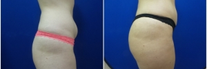 buttock-fat-transfer-2-2