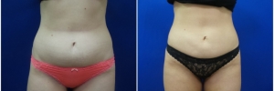 buttock-fat-transfer-2-3